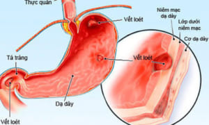 Rối loạn thần kinh thực vật dạ dày