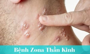 Bị Zona Thần Kinh Bôi Thuốc Gì