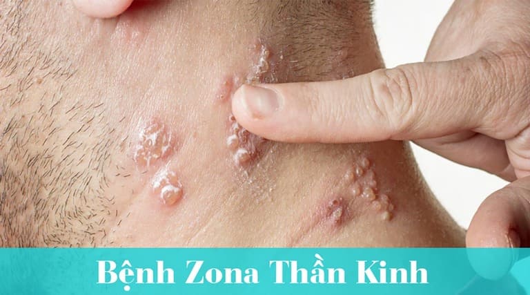 Bị Zona Thần Kinh Bôi Thuốc Gì