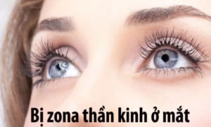 Bị Zona Thần Kinh Ở Mắt