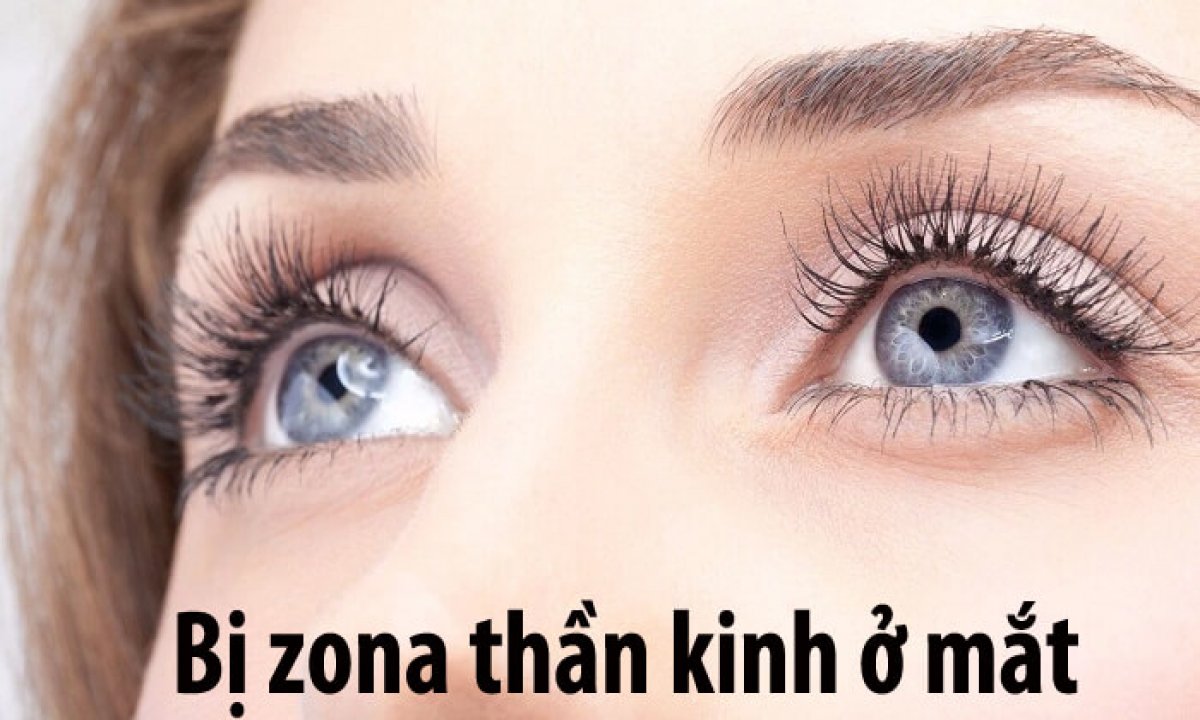 Bị Zona Thần Kinh Ở Mắt