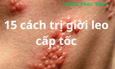 Cách Trị Giời Leo Cấp Tốc