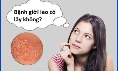 Giời Leo Có Lây Không