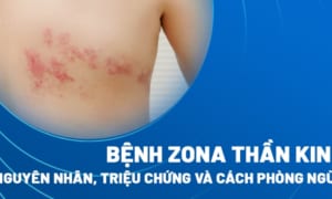 Triệu Chứng Của Zona Thần Kinh