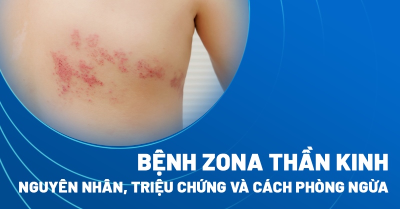 Triệu Chứng Của Zona Thần Kinh