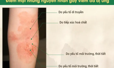 Nguyên nhân Gây Viêm Da Dị ứng