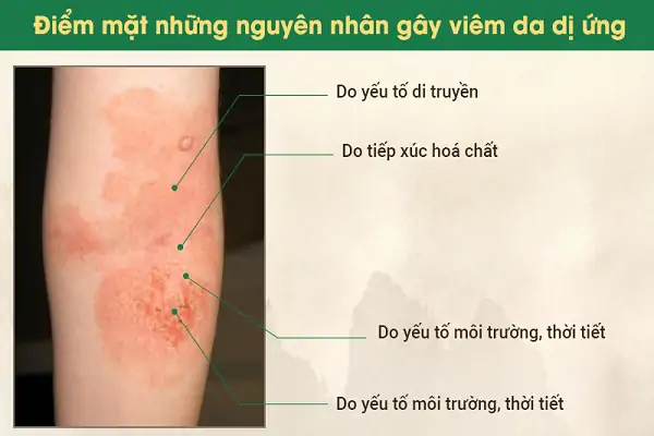 Nguyên nhân Gây Viêm Da Dị ứng