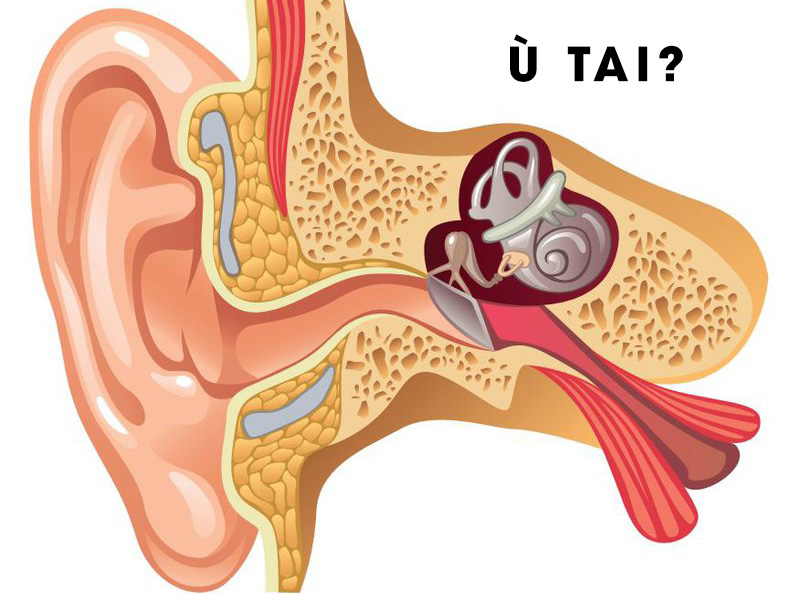 Chữa ù tai nghe tiếng mạch đập